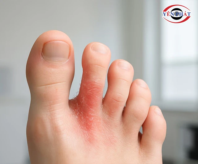 nấm kẽ chân do đi giày da bị mốc